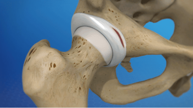 Do Labral Tears Cause Hip Pain