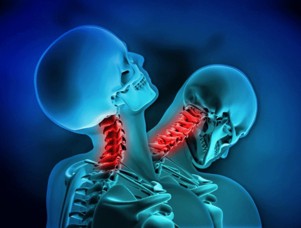 Four Whiplash Myths