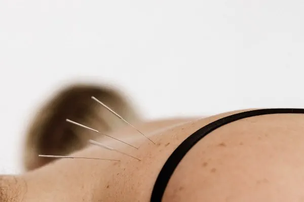 Close-up of an acupuncture practitioner inserting a sterile needle into a patient's upper back, with additional needles already in place during a dry needling treatment.