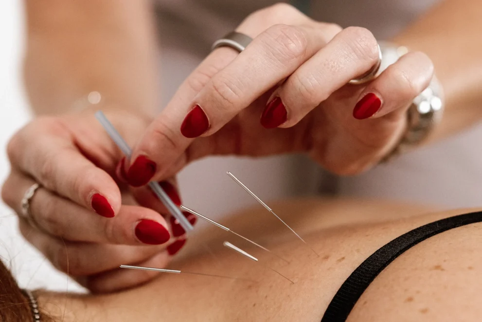 Close-up of an acupuncture practitioner inserting a sterile needle into a patient's upper back, with additional needles already in place during a dry needling treatment.