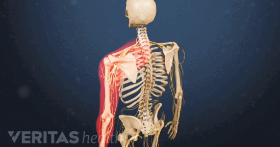 Neck Pain and Cervical Disk Herniation